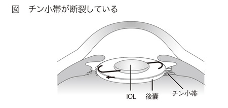 ［図表1］チン小帯が断裂している