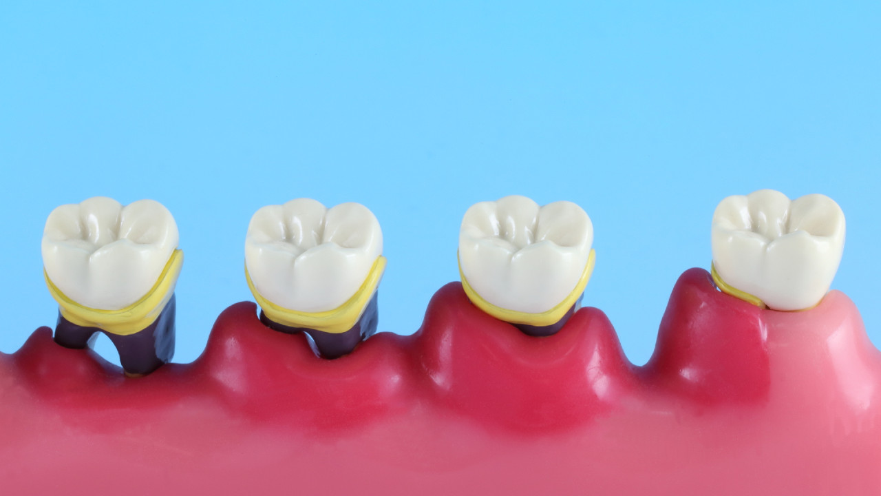 【歯周病】高齢者ほどなりやすいのはなぜ？歯を失わないために知っておきたい事実（歯科医師が解説）