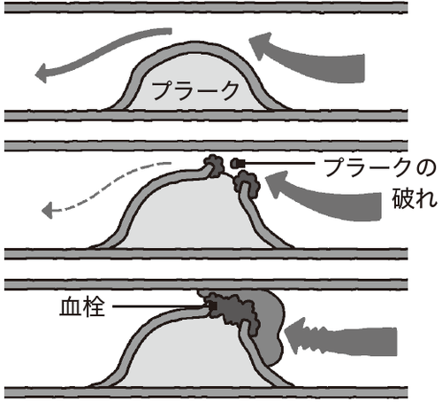 ［図表］血栓ができるまで