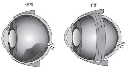 ［図表1］バックリング手術