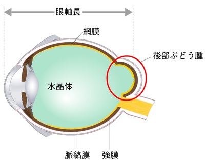 若者でも老眼に 目のぼやけ を引き起こす原因とは 富裕層向け資産防衛メディア 幻冬舎ゴールドオンライン