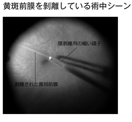 不快な視界の歪みをもたらす 黄斑前膜 いつ手術するべき 富裕層向け資産防衛メディア 幻冬舎ゴールドオンライン