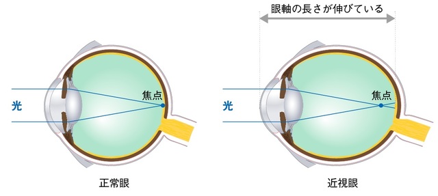 遠くが見えにくい 手元がぼやける 視力低下に潜む病気とは 富裕層向け資産防衛メディア 幻冬舎ゴールドオンライン
