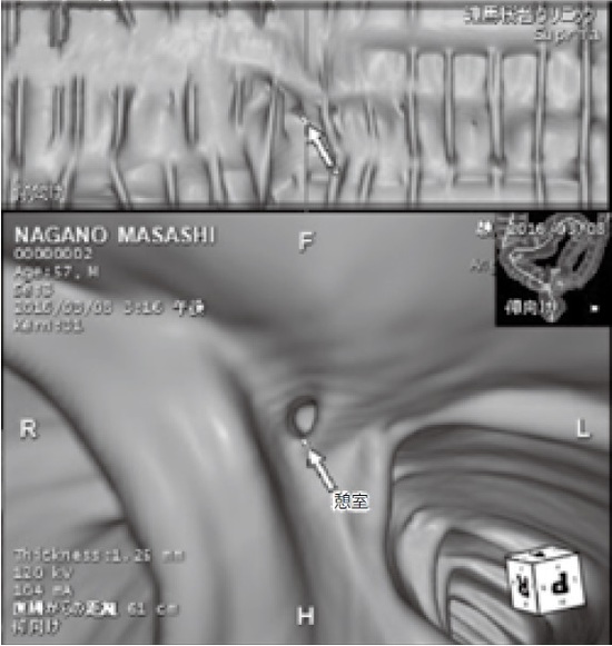 憩室（大腸壁にできた袋）があることがよく分かる