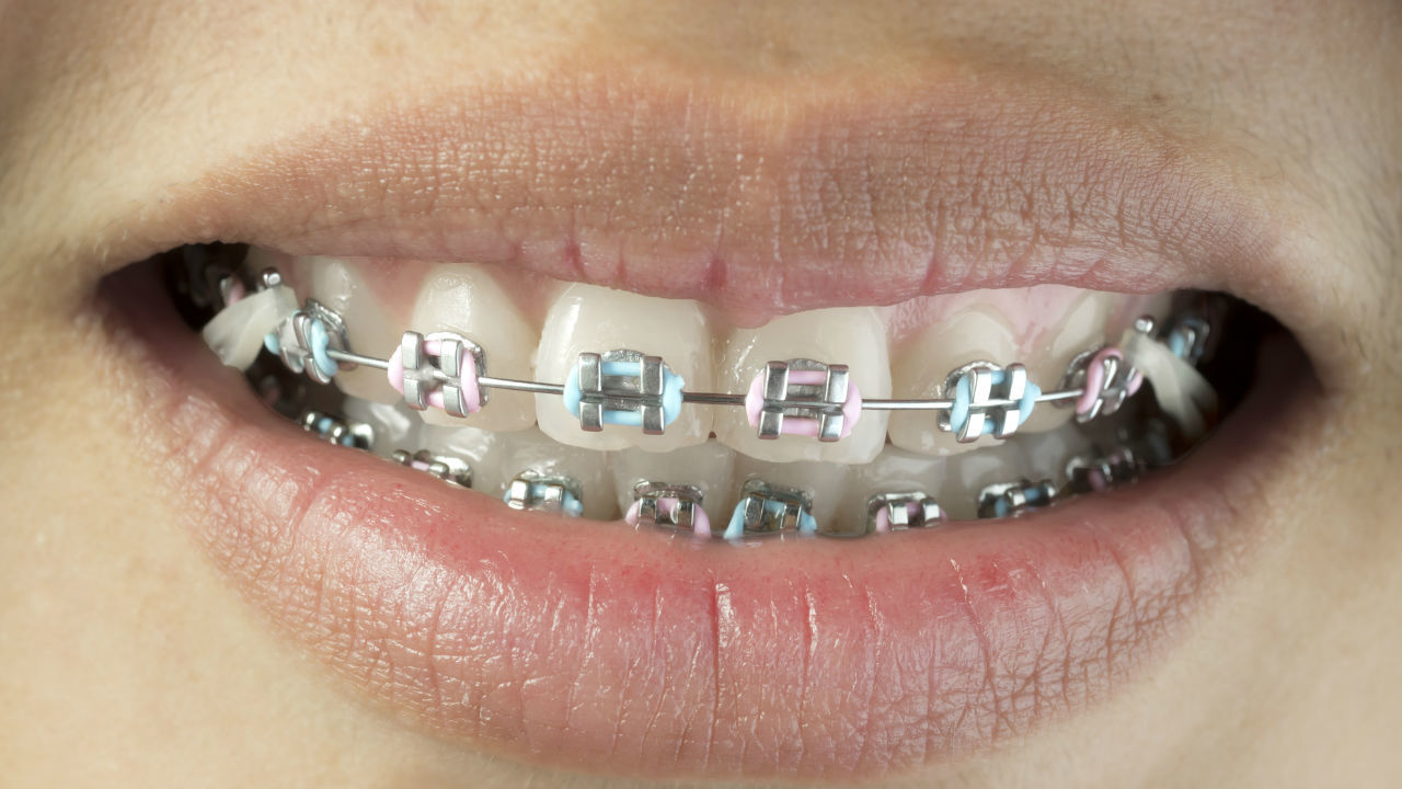 欧米では一般的な 「矯正歯科治療＝ステイタス」という文化