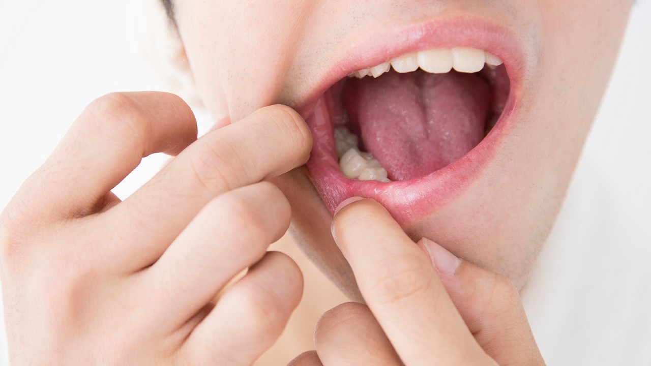 〈なかなか治らない口内炎〉は要注意…年々増えている「舌ガン」の危険な兆候【歯科医師が解説】
