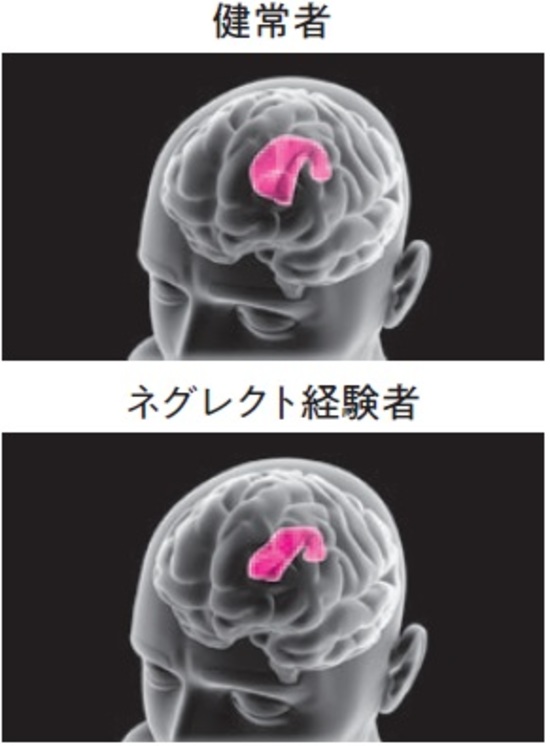 子ども時代に虐待で 脳に大きな傷 心理療法で回復するか 富裕層向け資産防衛メディア 幻冬舎ゴールドオンライン