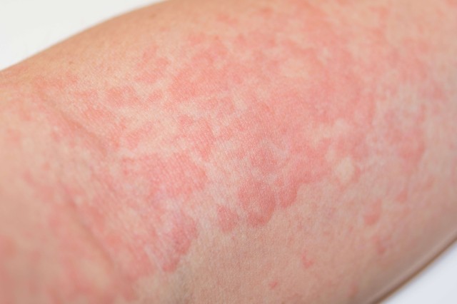 血管浮腫はどのように診断されますか?