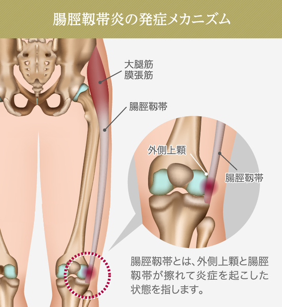 だいたい きん まく ちょう きん 痛み 股関節の外側が痛い それは大転子部滑液包炎かも Documents Openideo Com