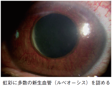 急に見えなくなる 糖尿病による眼疾患 の恐ろしい末期症状 富裕層向け資産防衛メディア 幻冬舎ゴールドオンライン