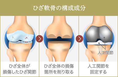 ひざ」の人工関節手術〜知っておくべき重要事項とは？ | ゴールド 